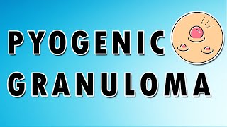 Pyogenic Granuloma Symptoms Treatment and Causes [upl. by Francene284]