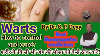 Warts  मस्सा  Best Homeopathic medicines for all type  Tips from a experience Doctor [upl. by Cowie145]