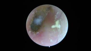 Cleaning moldy ears Ear cleaning [upl. by Macur]