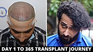 FUE Hair Transplant Timeline I Day 1 to Day 365 I Before amp After  Born Creator [upl. by Markos655]