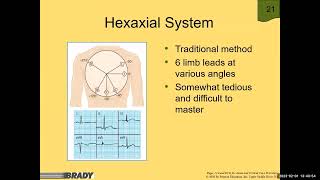 Determining Axis and Hemiblock  12 Lead ECG [upl. by Kevina]