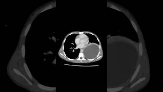 Pulmonary hydatid cyst ctchest [upl. by Tabb201]