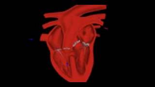 Auscultation communication intraventriculaire [upl. by Britta421]