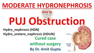 PUJ Obstruction moderate HYDRONEPHROSIS cured case [upl. by Jecon]