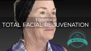 69 yo Female Total Facial Rejuvenation  An Amazing Transformation  Aesthetic Minutes Facelift [upl. by Aisatsana]