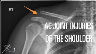 Acromioclavicular AC joint injury Mechanism of injury diagnosis and treatment [upl. by Caylor140]