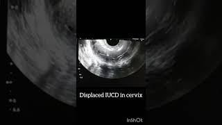 Displaced IUCD in the cervix ultrasound pregnant contraceptives [upl. by Liryc758]