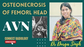 OSTEONECROSIS OF FEMORAL HEAD  AVASCULAR NECROSIS OF FEMORAL HEAD  AVN [upl. by Lasiaf]