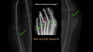 Bone and joint alignment 5 Musculoskeletal Xray General Systematic approach RadiologyChannel [upl. by Eylsel]