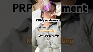 Face PRP treatment prptreatment faceprp microneedling dailyshorts dailyvlog acnetreatment yt [upl. by Eceinaj]