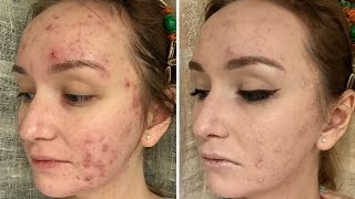 Макияж для АКНЕ  Vichy Dermablend 3D PROнеуверенность [upl. by Uehttam841]