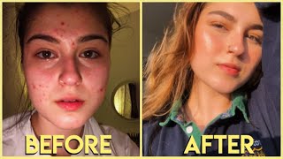 how i TRANSFORMED my skin on a budget [upl. by Carla]