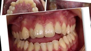 Invisalign to solve a Severe Open Bite and crowding [upl. by Asiled]