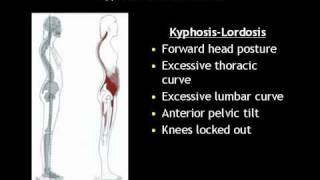 What is Kyphosis Lordosis [upl. by Acira]