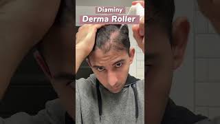 How to use derma roller to treat hair loss at home hairloss alopecia dermaroller mesotherapy [upl. by Norrehc]