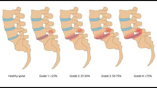 Physiotherapy management for Lumbar spondylolisthesis StayHome and study WithMe [upl. by Ridan]