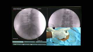 Transforaminal Epidural Under Ultrasound  Transforaminal Epidural Injection Technique [upl. by Friede]