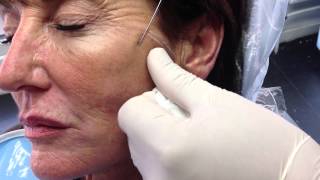 NonSurgical Face ThreadLift Procedure [upl. by Aisinut]