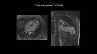 How to assess a left ventricular thrombus with the help of cardiac MRI CMR [upl. by Nevile389]