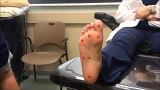 Neurologic Examination of the Foot 10gm Monofilament Test [upl. by Nivlac]