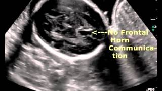 Septooptic dysplasia [upl. by Stedman]