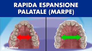 ESPANSIONE rapida del PALATO MARPE negli adulti © [upl. by Rbma]