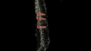 Pedicle Screw Fixation of Lumbar body Compression Fracture [upl. by Zitvaa806]