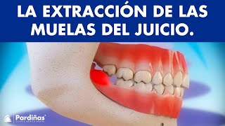 Extracción de muelas del juicio y pericoronatis  ¿Por qué se extraen las cordales © [upl. by Tichonn]