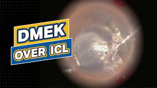 DMEK over ICL [upl. by Lavotsirc]