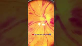 Flame shaped Hemorrhages  proliferative diabetic retinopathy PDR  Short Video 180 [upl. by Kciredohr679]