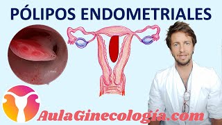 PÓLIPOS UTERINOS Causas riesgo de cáncer diagnóstico y tratamiento  Ginecología y Obstetricia [upl. by Brigitte268]