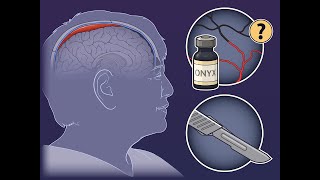 Middle Meningeal Artery Embolization for Subdural Hematoma  NEJM [upl. by Ttnerb]