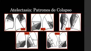 Patología Torácica en Radiología Convencional [upl. by Yldarb]