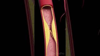 Atherosclerosis The Silent Build UpFollowAtherosclerosis occurs when fatty deposits [upl. by Ezarra]