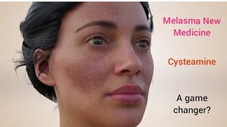 Melasma New Medicine  Cysteamine  Is it a game changer melasma melasmacream melasmatreatment [upl. by Ontine]