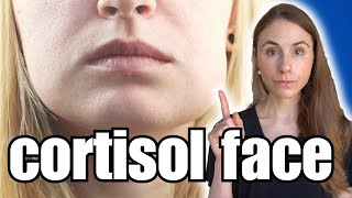 Do You Suffer From Cortisol Face [upl. by Case]