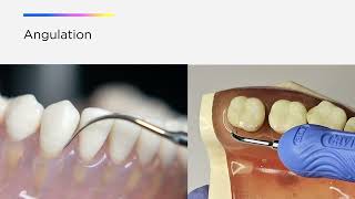 Optimize your Cavitron® Ultrasonic Technology The Three A’s of Ultrasonic Instrumentation [upl. by Alessandro581]