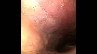 Hasen Julia Nasal Endoscopy Spasm Dec 23 [upl. by Adnilrem]