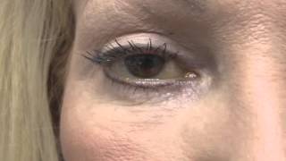 Management of PostBlepharoplasty Chemosis [upl. by Edaj]