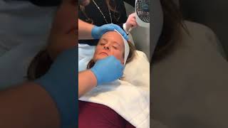 Illuminize peel by SkinMedica Performed by Nick Miller [upl. by Emelita205]