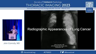 Radiographic Appearances of Lung Cancer [upl. by Smukler86]