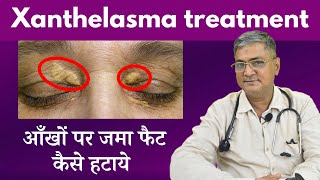 Xanthelasma Eye cholesterol kam karne ke upay  eye cholesterol treatment  Xanthelasma removal [upl. by Oravla]