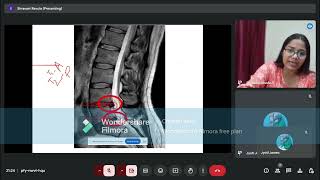 Prolapsed Intervertebral Disc Anatomy of IV Disc Part 2 [upl. by Clarice]