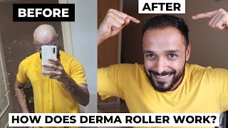 Derma Roller hair regrowth before and after  Does Microneedling actually work in reducing DHT [upl. by Ahseki]