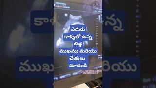 Breech presentation in 9th month drkranthigynecologist తొమ్మిదవ నెల లో ఎదురు కాళ్ళు [upl. by Noiraa]