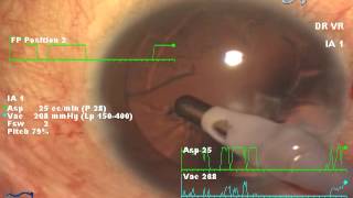 Grade 2 cataract small nucleus [upl. by Latsyc]