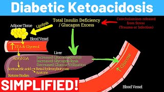 What is Diabetic Ketoacidosis  Complications of Diabetes  Panmedicad [upl. by Gayner]