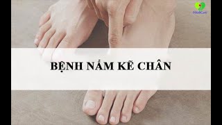 Nấm kẽ chân là gì Triệu chứng và cách điều trị hiệu quả tại nhà [upl. by Asiulana]