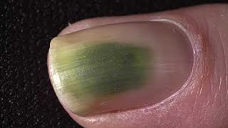 Green Toenail Fungus Cure Home Treatment Guide [upl. by Chilson]