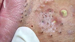 Big Cystic Acne Blackheads Extraction Blackheads amp Milia Whiteheads Removal Pimple Popping  3667 [upl. by Idnaj]